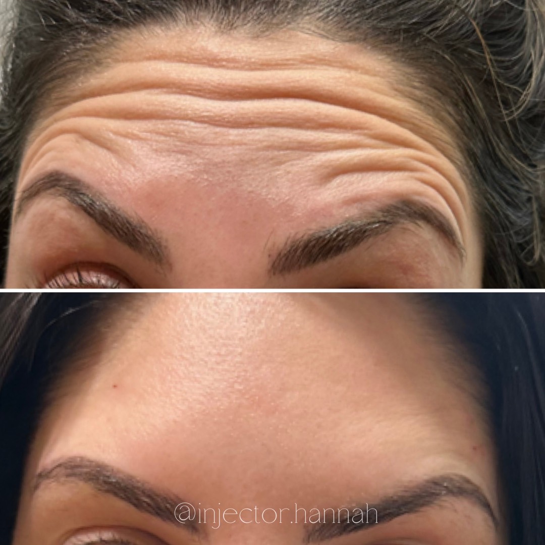 Forehead lines before/after – smoother after 2 weeks